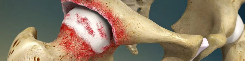 FOXO4-DRI Osteoarthritis | Shaanxi BLOOM Tech Co., Ltd FOXO4-DRI Osteoarthritis | Shaanxi BLOOM Tech Co., Ltd