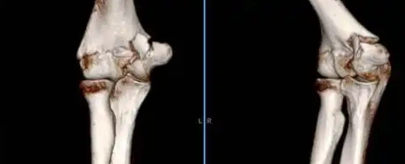 Teriparatide Acetate Cost | Shaanxi BLOOM Tech Co., Ltd Teriparatide Acetate Cost | Shaanxi BLOOM Tech Co., Ltd