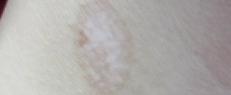 Nonapeptide-1 skin | Shaanxi BLOOM Tech Co., Ltd Nonapeptide-1 skin | Shaanxi BLOOM Tech Co., Ltd